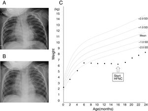 Chest X-ray images before the initiation of high-flow nasal cannula (A) and 1 month (B) after the initiation of high-flow nasal cannula. (C) Growth chart of the patient. Source: Ref. 5.