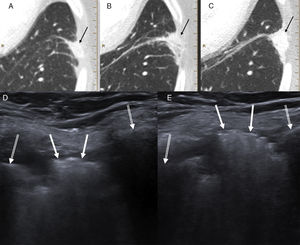 A-C) La TC en controles seriados mostró una opacidad pulmonar periférica laterobasal izquierda con discreta extensión al espacio intercostal que había aumentado de tamaño y densidad progresivamente (flechas negras). D) La ecografía torácica (sin maniobra de Valsalva) demostró la presencia de una lesión hiperecogénica (flechas blancas) en el espacio intercostal entre los arcos laterales de la séptima y octava costillas izquierdas (flechas blancas dobles), que se movilizaba con la respiración. E) Al realizar maniobra de Valsalva, dicha lesión protruía significativamente hacia la pared torácica. El enfermo fue diagnosticado de hernia pulmonar intercostal probablemente con relación a la vía de entrada de la toracoscopia para la realización de una lobectomía superior izquierda.