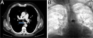 A) TC con contraste, corte axial, donde se aprecia un aneurisma sacular en el origen de la arteria bronquial izquierda (flecha). B) Radiografía simple de tórax postembolización con «coils» del aneurisma de la arteria bronquial izquierda.