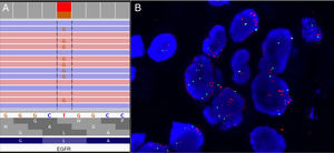 (A) Liver biopsy: NGS (Oncomine Solid Tumor DNA) detects an EGFR mutation in exon 21. (B) Liver biopsy: MET FISH (Abbot Vysis Probe Kit) showing a typical amplification pattern.