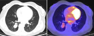 Tomografía por emisión de positrones-tomografía computarizada (PET-TC). Lesión polilobulada localizada en el lóbulo inferior derecho con captación leve (SUVmax: 2,68).
