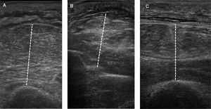 Ecografía muscular periférica. Espesor muscular evaluado a nivel de la logia flexora del brazo (A), logia flexora del antebrazo (B) y cuádriceps (C).