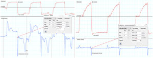 Compressible volume identification in flow waveform, through a pre use test (see text for more details). (a) A clinical tracing of a patient, demonstrating a double peak in expiratory flow waveform. (b) The results of a pre-use test to determine semiology associated with compressible volume, which produces an initial 100ms peak. This peak was systematically ruled out in the PCF estimation (e.g., in (a), the second peak, labelled as PCF represents the true PCF).