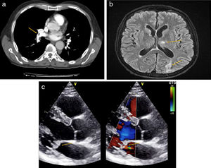 a) Angio-TC de arterias pulmonares. Defecto de repleción arterias del lóbulo inferior derecho e inferior izquierdo compatibles con TEP, flecha. b) RM cerebral en fase T2. Impactos isquémicos en hemisferios cerebelosos y en región occipital, flechas. c) Ecocardiograma en eje paraesternal largo. Insuficiencia mitral severa y masas endocárdicas sobre válvula mitral, indicado con flechas.