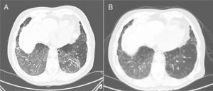 1A: Tomografía computarizada en la que se aprecia un infiltrado en vidrio deslustrado en ambas bases pulmonares y LM, con engrosamiento lineal asociado de septos interlobulillares. 1B: Tomografía axial computarizada de control, realizada a los 3 meses del cambio de tratamiento de acenocumarol por apixabán, con un tenue infiltrado en vidrio deslustrado parcheado en bases, con mejoría significativa con respecto a la previa.