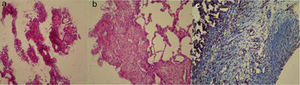 (a) The multi-layer mesothelial reaction of visceral pleura in sericin group (HE ×200); (b) fibrosis in the visceral pleura in sericin group (HE ×200); (c) dense collagen fibers of visceral pleura in sericin group (Masson