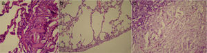 (a) Foreign body reaction in the lung parenchyma in talcum powder group (HE ×200); (b) emphysema of parenchyma in talcum powder group (HE ×200); (c) presence of tissue glue in the lung parenchyma in talcum powder group (HE ×200).