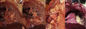 (a, b) The pleural adhesions and pleurodesis success of sericin; (c, d) the accumulation of talcum powder in the thoracic wall and mediastinum after talcum pleurodesis.