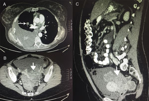 TAC del tumor de Krukenberg. A) Corte axial de la TAC a nivel del tórax donde se observa el derrame pleural (DP) derecho y un nódulo pulmonar parahiliar derecho. B) Corte axial de la TAC a nivel de pelvis donde se observa la masa pélvica. C) Corte sagital de la TAC donde se visualiza la masa pélvica.