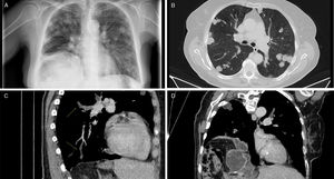 A) Radiografía de tórax. B) TC pulmonar, corte axial: nódulos de densidad liquida. C) TC pulmonar, corte sagital: las flechas señalan las imágenes nodulares localizadas en el interior de ramas arteriales. D) TC pulmonar, corte coronal: transición hepático-torácica de quiste hidatídico.
