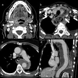 a) Corte axial de la TC cervical a nivel de la epiglotis, observándose un absceso milimétrico en la porción inferior de la amígdala palatina derecha (flecha); b) Corte axial de la TC cervical a nivel del tiroides, identificándose una colección con gas que rodea el lóbulo tiroideo izquierdo anteriormente, para después progresar posteriormente introduciéndose en el tórax a través del orificio torácico superior izquierdo (flecha); c) Corte axial de la TC torácica a nivel de la carina, se visualiza la colección situada en mediastino medio y posterior rodeando a la aorta torácica en más de 180°. Ejerce efecto de masa sobre el esófago medio (asterisco), y d) Corte sagital oblicuo de la TC torácica donde se aprecia la colección extendiéndose a lo largo de toda la longitud de la aorta torácica descendente. Se aprecia derrame pleural de pequeña cuantía.