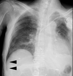 Chest X-ray image of the patient with the indicated narrow, sharp, and black air line forward to the abdominal region at the right costophrenic angle, which represents the deep sulcus sign in pneumothorax.