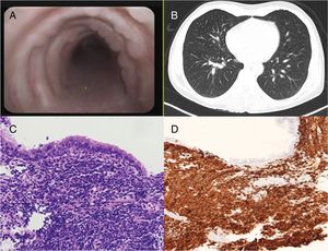 A) Tráquea con múltiples nódulos confluyentes que revierten la pared visualizados mediante fibrobroncoscopia flexible. B) Imagen de TC donde se objetiva patrón de árbol en brote (tree-in-bud) de predominio en lóbulo superior derecho. C y D) Secciones histológicas de la mucosa bronquial que muestran una proliferación de células de aspecto linfoide, tinción de hematoxilina/eosina (C), positivas para CD20, estudio inmunohistoquímico (D).