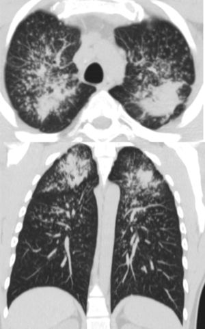 TCAR de tórax con patrón intersticial nodular con masas de FMP de un trabajador de 34 años de edad y 8 años de exposición a conglomerados de cuarzo. FMP: fibrosis masiva progresiva.