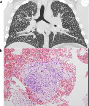 A) TCAR de tórax de trabajador de 26 años, con historia de exposición de 8 años a conglomerados artificiales de cuarzo: muestra patrón intersticial micronodular difuso con adenopatías hiliares e infracarinales. B) Criobiopsia que muestra nódulos característicos de silicosis.