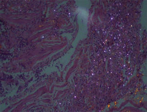 La microscopia óptica con luz polarizada muestra partículas birrefringentes en relación con sílice sobre áreas de fibrosis intersticial.