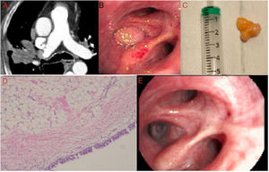 A) Lesión de densidad grasa en la TAC de tórax en el bronquio segmentario anterior del lóbulo superior derecho. B) Exploración con FBC flexible observando la lesión que ocupa entrada a segmentario anterior del lóbulo superior derecho. C) Imagen de la lesión tras su exéresis. D) Imagen histológica de la lesión (×10). E) Imagen de recanalización del bronquio segmentario anterior del lóbulo superior derecho tras el tratamiento.