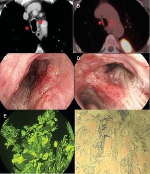 A y B: tomografía axial computarizada y PET. C y D: placas eritematosas sobreelevadas e hipervascularizadas en tercio medio derecho traqueal y carina principal con extensión a lo largo de la pared medial del bronquio principal derecho. E y F: presencia de depósitos acidófilos en la submucosa correspondientes a sustancia amiloide tras tinción específica con rojo congo y tioflavina T.