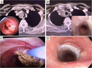 A) Muestra la imagen de la broncoscopia y la TC de la estenosis traqueal que padecía la paciente. B) Muestra los resultados obtenidos tras el tratamiento con corticoides y la prótesis, después de 4 meses. C) Coagulación con láser argón plasma, tras la biopsia. D) Colocación de prótesis Dumon®.