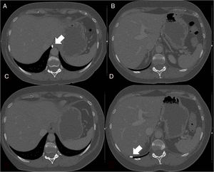A y B) Imágenes en ventana de hueso de la TC torácica donde se observa el nódulo pleural derecho calcificado adyacente al hiato esofágico. C y D) Imágenes en ventana de hueso de una TC de control posterior a las imágenes A y B en las que el nódulo pleural calcificado ha migrado hasta el receso costofrénico posterior.
