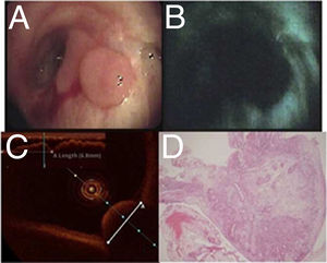 A) Lesión nodular de 7,8mm en el muñón posneumonectomía tras visión con luz blanca convencional. B) Exploración endoscópica con autofluorescencia, con pérdida de apariencia convencional. C) Tomografía de coherencia óptica que revela integridad de la membrana basal. D) Muestra histológica bajo tinción con hematoxilina eosina, con magnificación ×10 que permite apreciar la transición en el epitelio respiratorio normal con una protuberancia en el interior de la luz bronquial bien delimitada con presencia de rasgos angioblásticos y abundantes leucocitos (subtipos polimorfonucleares), compatible con hemangioma capilar lobar.