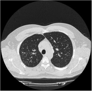TC torácica. Patrón micronodular difuso en ambos campos pulmonares.