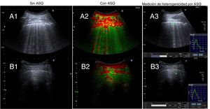 Ecografía pulmonar sin ASQ y con ASQ. Grupo 1. A1: sin método ASQ, existe rugosidad, engrosamiento y desestructuración de la línea pleural y múltiples líneas B. A2 y A3: método ASQ, representación multiparamétrica y medición de la heterogenicidad pulmonar, respectivamente. Grupo 2. B1: sin método ASQ, existe línea pleural fina y conservada, líneas B (menos de 3) y líneas A. B2 y B3: método ASQ, representación multiparamétrica y medición de la heterogenicidad pulmonar, respectivamente.