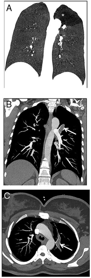 The reformat coronal CT at maximum inspiration (A) shows a non-contrast enhancing tubular lesion with surrounding hypoattenuation of the apicoposterior segment of the left upper lobe (asterisk), a finding indicative of hyperinflation. The coronal CT scan also demonstrates aerial trapping in the apicoposterior segment of the left upper lobe. The contrast enhanced maximum intensity projection images (B and C) reveal no connection between the non-contrast tubular lesion (arrows) and pulmonary artery of the apicoposterior segment in the left upper lobe.