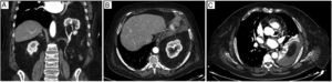 A) Tomografía computarizada coronal que muestra la HDB con contenido de riñón izquierdo intratorácico. B y C) Tomografía computarizada axial que muestra derrame pleural y atelectasia del lóbulo inferior izquierdo.