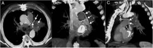 Axial (A), coronal (B), and sagittal (C) maximum intensity projection (MIP) thoracic CT images (mediastinal window) show a left hilar mass (asterisk) encasing the left internal mammary artery graft to the left anterior descending coronary artery (arrows).