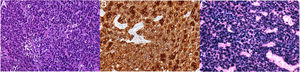 A) Tinción de hematoxilina-eosina ×100, donde se observan áreas de clara diferenciación epitelial con citoplasmas amplios y eosinófilos, y muy abundantes linfocitos en el estroma. B) El estudio inmunohistoquímico es positivo para citoqueratina AE1/AE3. C) Llamativa positividad de todas las células epiteliales atípicas para EBER (VEB-encoded small nuclear RNA).