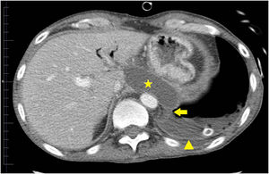 TC con contraste intravenoso (en plano axial), que muestra una colección líquida de morfología ovalada, de paredes bien delimitadas (estrella), en localización retrogástrica que se comunica (flecha gruesa) con un derrame pleural izquierdo (cabeza de flecha).