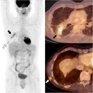 18FDG-PET-CT showing confluent hypermetabolic nodules in the right lower lobe (black arrows) and two small hypermetabolic subcutaneous nodules in the right thoracic wall (white arrows).
