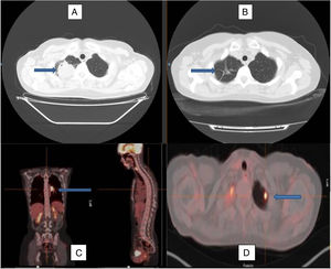 Imagen de tomografía axial computarizada al diagnóstico (A) y tras el tratamiento con corticoides (B), observándose la remisión de la lesión en el lóbulo superior derecho, permaneciendo en su localización algunos tractos fibrosos residuales (flechas). Imagen de PET-TAC con imagen hipercaptante en el hilio pulmonar izquierdo (C) y en el lóbulo superior izquierdo (D), marcadas por las flechas, que reflejan la afectación multilocular del caso.