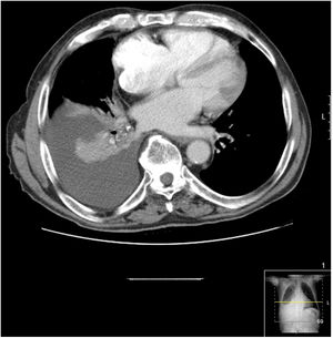 TC en la que se observa derrame pleural derecho con pérdida de volumen asociada.