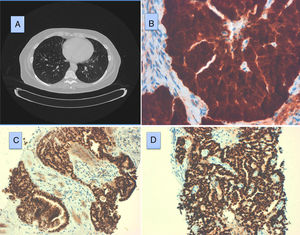 (A) Thorax computed tomography scan showing bilateral multiple nodules. (B) Tumor cells showing strong, diffuse staining for β-catenin. β-Catenin 400×. (C) Diffuse staining of tumor cell nuclei with thyroid transcription factor (TTF-1). TTF-1, 200×. (D) Tumor cells showing diffuse, strong staining with progesterone receptors. Progesterone receptor, 200×.