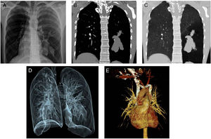 (A) Chest X-ray reveals tubular opacities in the lower zone of the left lung. (B) Contrast-enhanced CT shows non-enhanced tubular lesions compatible with mucocele in the superior and posterior segments of the left lower lobe. (C and D) There is also air trapping in the lower lobe of the left lung. (E) 3D CT image demonstrates a persistent left superior vena cava in the left side of the mediastinum.