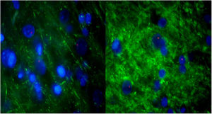 Consecutive sections of the previously described alveolar-like tissue in which we performed both FISH and IHQ (using antibodies against protein B of pulmonary surfactant) for characterization of the present cells. Under the fluorescence microscope (40×), red color indicates Sry region (CrY), nuclei can be seen in blue, and green represents protein B expression. As it can be observed, BMSCs are present in the alveolar-like tissue and they are producing protein B of pulmonary surfactant. Cells without Sry region marked with red, might be either BMSC or other cells whose differentiation might have been induced by BMSC.