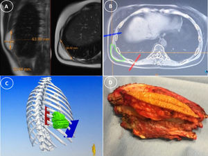 A) Resonancia magnética de tórax de la paciente previa a la primera cirugía. B) Reconstrucción tomográfica de la lesión original a partir de la resonancia. C) Navegación intraoperatoria. D) Pieza quirúrgica de resección en bloque.