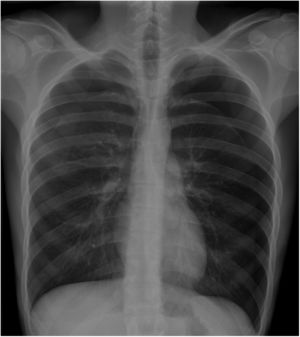 Radiografía de tórax en inspiración máxima, que muestra neumotórax completo izquierdo y neumotórax parcial derecho.