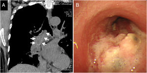 (A) Computed tomography showing an intrabronchial lesion extending from the right main bronchus to the lower bronchus (arrows). (B) Bronchoscopic examination showing a protruding lesion with an irregular surface and necrosis, detected in the endobronchial region of the right main bronchus.