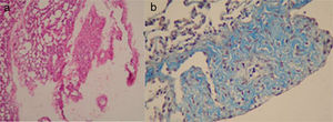 (a) Fibrosis and fibrin organization in the visceral pleura in Group-B (HE×200); (b) dense collagen fibers of visceral pleura in Group-B (Masson's trichrome×200).