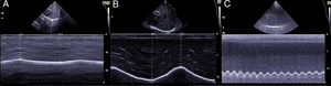 Cúpula diafragmática en modos «2D» y «M anatómico» y mediciones de desplazamiento de la cúpula en A) desplazamiento en volumen corriente, B) desplazamiento en capacidad vital, C) maniobras de sniff.