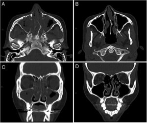 Tomografía de senos paranasales, corte axial (A y B) y corte coronal (C y D). A y C) Pre-tratamiento con mepolizumab: desviación septal a izquierda. Marcado engrosamiento mucoso de ambos senos maxilares, celdillas etmoidales y ambas fosas nasales. Presencia de exudado a nivel de ambos senos maxilares. B y D) Después de 4 meses de tratamiento con mepolizumab: mínimo engrosamiento de los senos maxilares. Engrosamiento mucoso y formaciones polipoideas de ambas fosas nasales.