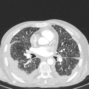 TC torácica de alta resolución. Se observan hallazgos compatibles con enfermedad secundaria a enfermedad de Crohn una vez descartadas etiologías infecciosas.