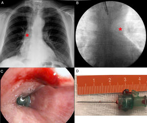A) Estructura radiopaca alojada en bronquio intermediario. B) Cuerpo extraño en el bronquio principal izquierdo visible mediante fluoroscopia. C) Visión endoscópica de CE. D) Aguja intramuscular de 2,5cm de longitud.