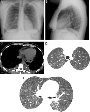 A y B) Proyecciones posteroanterior y lateral en la que no se visualizan consolidaciones parenquimatosas. Se observa un probable derrame pleural subpulmonar izquierdo de escasa cuantía al apreciar un aumento de la distancia entre la cámara gástrica y la base pulmonar izquierda. C) Imagen axial de la TC de tórax (ventana de mediastino) en la que se identifica un derrame pleural bilateral (asteriscos blancos) y un derrame pericárdico (asteriscos negros) de nueva aparición. D y E) Imágenes axiales de la TC de tórax (ventana de parénquima pulmonar) en las que se observan opacidades bilaterales de atenuación en vidrio deslustrado de nueva aparición.
