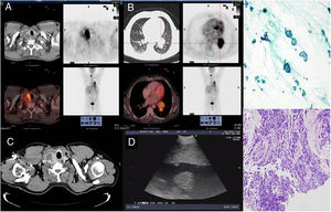 Las imágenes A y B se corresponden con cortes axiales del estudio PET/TC 18F-FDG: A) Las imágenes muestran un depósito patológico de FDG de aspecto hetereogéneo, que se proyecta sobre el nódulo tiroideo derecho objetivado en la tomografía computarizada. B) Lesión sólida con elevada captación de FDG en hilio izquierdo con signos de transcisuralidad. C) Corte axial de tomografía computarizada torácica a nivel cervical, que muestra un aumento de volumen nodular del LTD. D) Imagen por USEB del lóbulo tiroideo derecho. E) PATB de tiroides: población celular uniforme de células de Hürthle que se distribuye de manera discohesiva o en folículos, sugestivo de neoplasia folicular de células de Hürhle (tinción de Papanicolaou 40x). F) Biopsia bronquial: carcinoma pulmonar de célula pequeña (tinción de hematoxilina-eosina 20x).