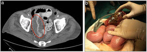 a) Corte TC donde observamos la imagen de la masa tumoral de carcinoma pulmonar responsable de la intususcepción y posterior perforación. b) Imagen intraoperatoria de la tumoración objetivándose perforación intestinal.