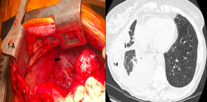 A: identificación de la fístula quilosa en el acto quirúrgico. B: TC mostrando el quilotórax refractario al tratamiento médico y dietético.